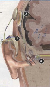 cochlear implant illustration